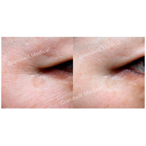 2ml Pcl Skin Booster Polycaprolactone Stimulating Skin Collagen Regeneration