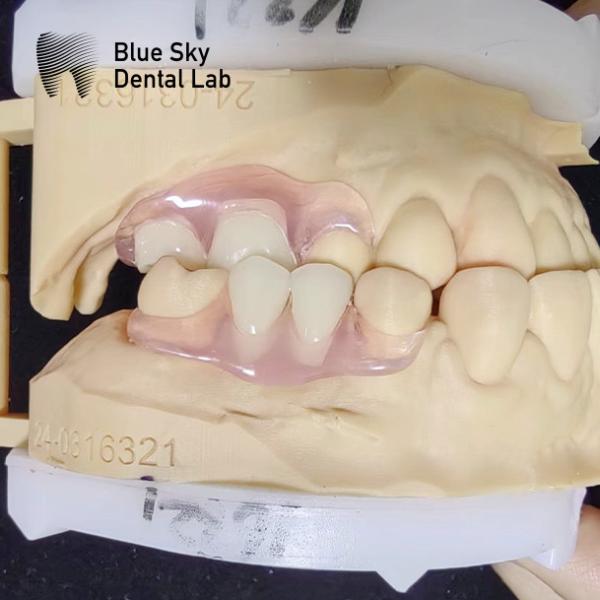 Smile Restoration Partial Acrylic Denture with clasps