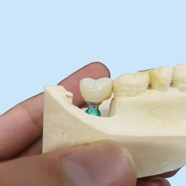 Ultra Hard Colour Stability OEM Dental Implant Crown Easy Maintain