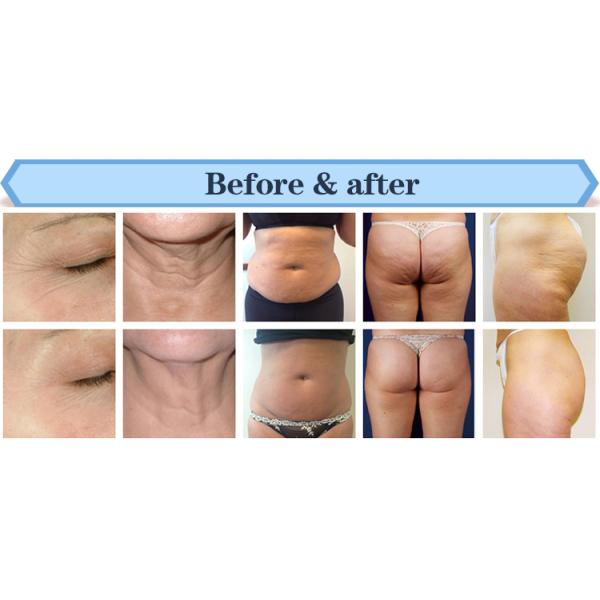 Factory Supplier Vacuum RF Cavitation Skin Tightening Body Slimming Machine With Medical CE
