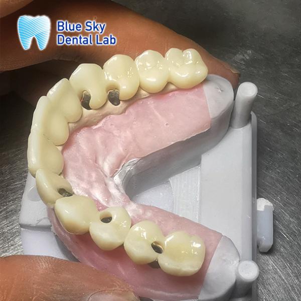 Nature Implant Procedure Cases with Universal Compatibility and Optimal Performance