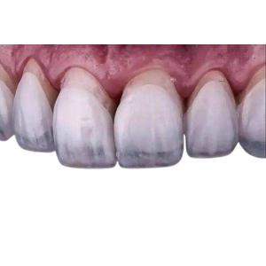 Buy cheap Dental Lab Dental Veneers Dentures Restorative Zirconia Crown Veneers product