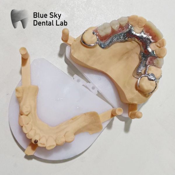 Dental Cast Partial Denture Framework Partial Dentures That Look Real