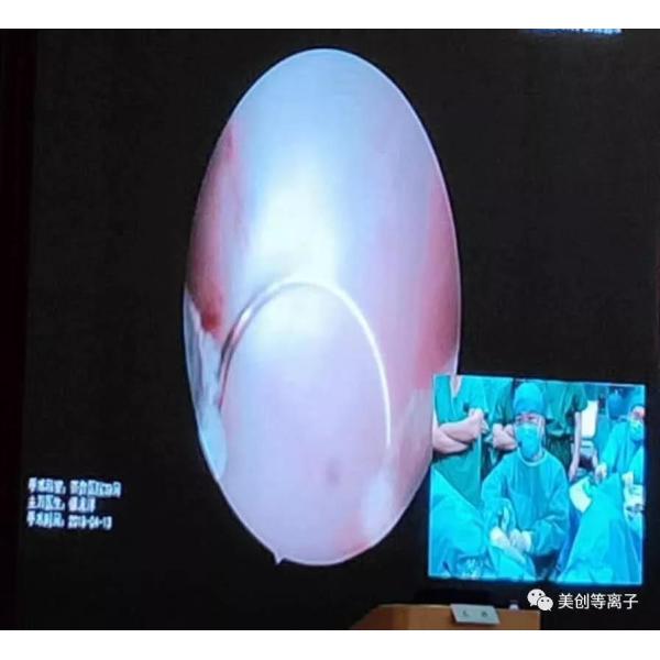 Bipolar BPH Surgery Probe Plasma Kinetic Cutting With CE / ISO Passed