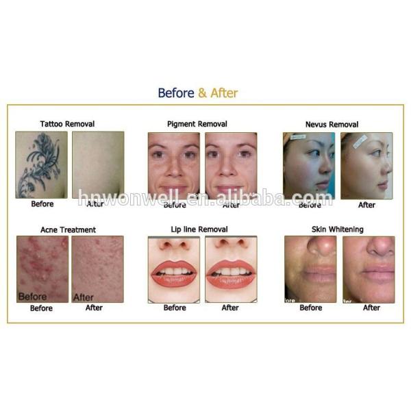 Q switched nd yag laser