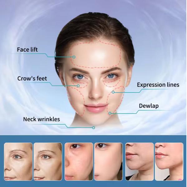 Portable MFFACE Pe-Face RF Microcurrent Face Lifting Double Chin Removal Machine