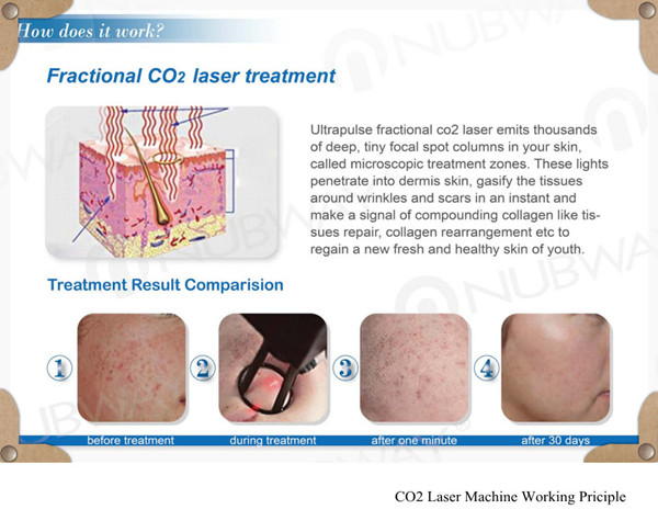 220V, 5A Lamp Pumped 2940 Er Yag Laser Fractional Co2 Laser Machine ER002