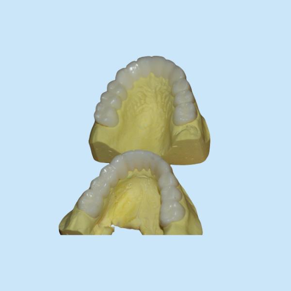 Temporary PFM Dental Crown