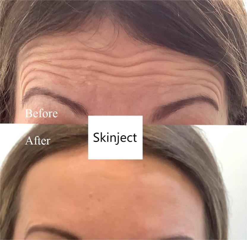 Botulinum Toxin Wrinkle Removal Anti Wrinkle Allergan s Dermal Fillers
