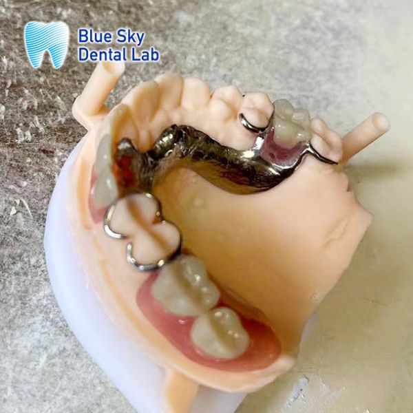 Adjustable Denture Metal Framework Resin Teeth Rpd Metal Framework