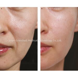 PCL Cross Linked Hyaluronic Acid Dermal Filler Polycaprolactone