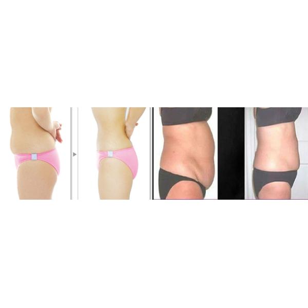 September Promotion!!! NUBWAY low price cryolipolysis apparatus