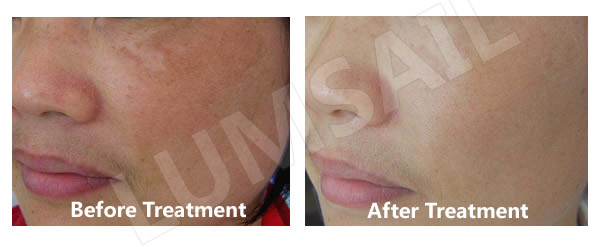 PDT LED Red Light Therapy For Skin / Wrinkles , Red Light Facial Therapy Devices