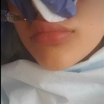 HA Injectable Dermal Facial Filler , Hyaluronic Acid injection Filler with Lidocaine