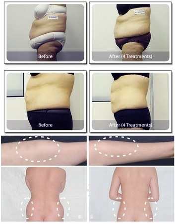 Lipo Laser Body Slimming Machine Laser Lipo