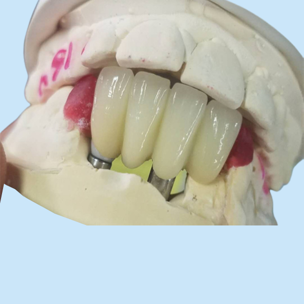 Strong Ti Base Milling Dental Implant Crowns Tooth Supported Bridge