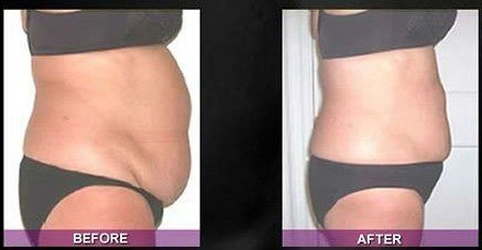 Professional Coolsculpting / Cryolipolysis slimming machine for weight loss, body shaping