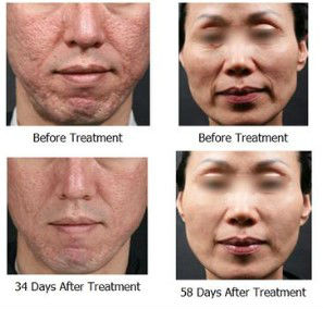 5mhz Touch High Quality Screen Thermage Skin Treatment Machine Nubway