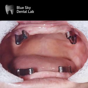 Buy cheap Resin Teeth Dental Titanium Bar Removable Blue Sky Implant System product