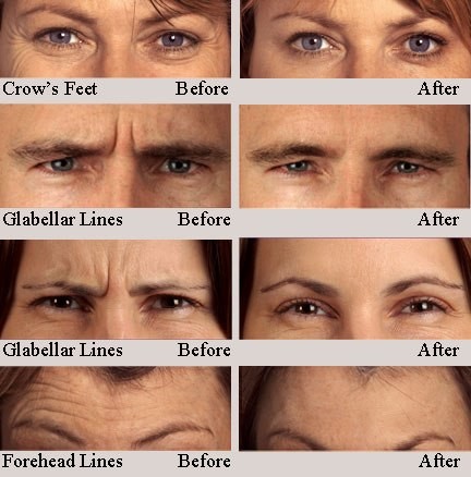 Face Thin Type A 100 IU Botulinum Toxin Korea Technology