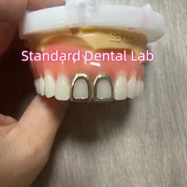 ISO Full Acrylic Dentures With Yellow Gold Teeth Open Face
