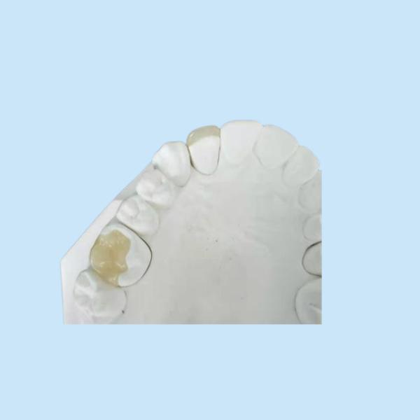 Durable Flexible PFM Bridge Crown Dental IPS E Max Press Inlay Onlay