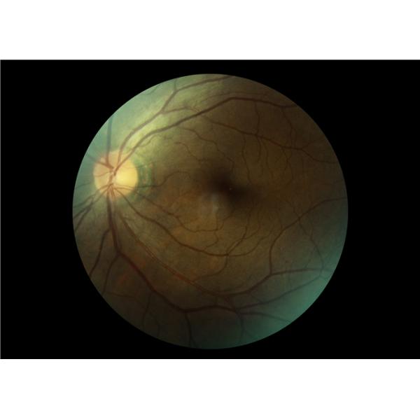 3.97 Inch Touch Screen 2.5mm Digital Retinal Camera