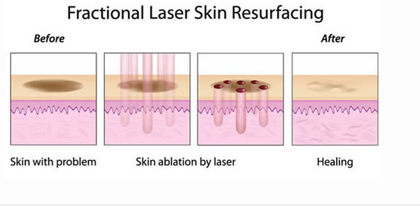 Mutiple patterns,strong laser generator,latest practical design,Forimi Fractional CO2 Laser Machine
