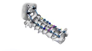 Buy cheap 40mm - 100mm CrCoMo Pedicle Screw Cervical Spinal Fusion System product