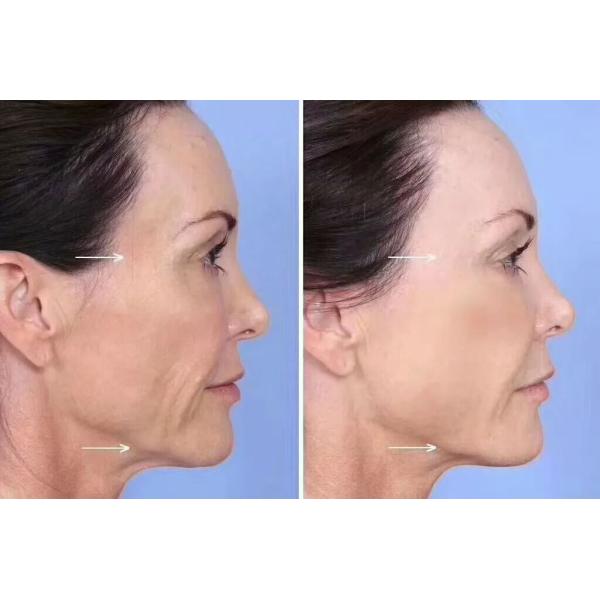 Dermal Filler Botulinum Toxin Type A 100 Units