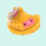 Customized Surgical Guides Flexible Planting Guide Resin