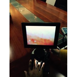 Hospital Microcirculation Microscope Nailfold Video Capillaroscope Detection