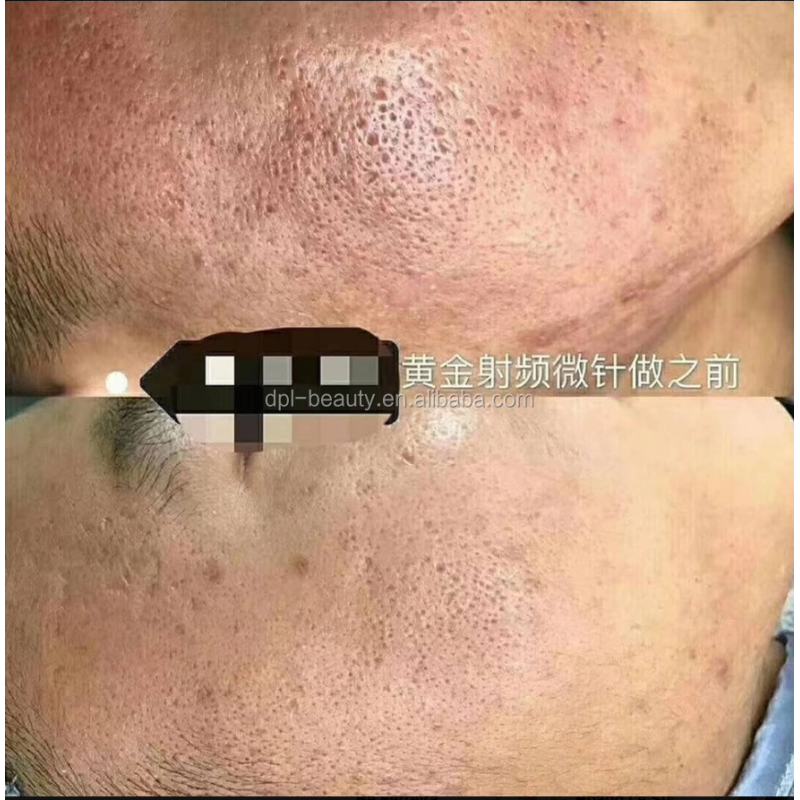 DPL Newest Radio Frequency RF Microneedling Beauty Machine/Rf Microneedling Machine/Gold Fractional RF Microneedling Machine