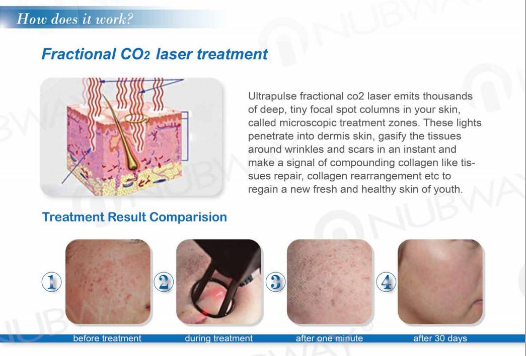 Medical laser system portable co2 fractional CO2 fractional laser wrinkles removal