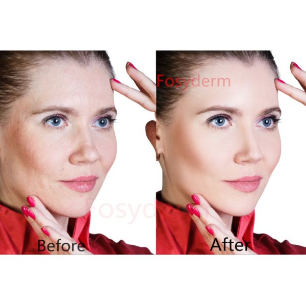 HA Injectable Dermal Facial Filler , Hyaluronic Acid injection Filler with Lidocaine