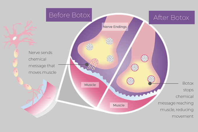 Korea Botulinum Injection For Wrinkles Folds Lose Weight